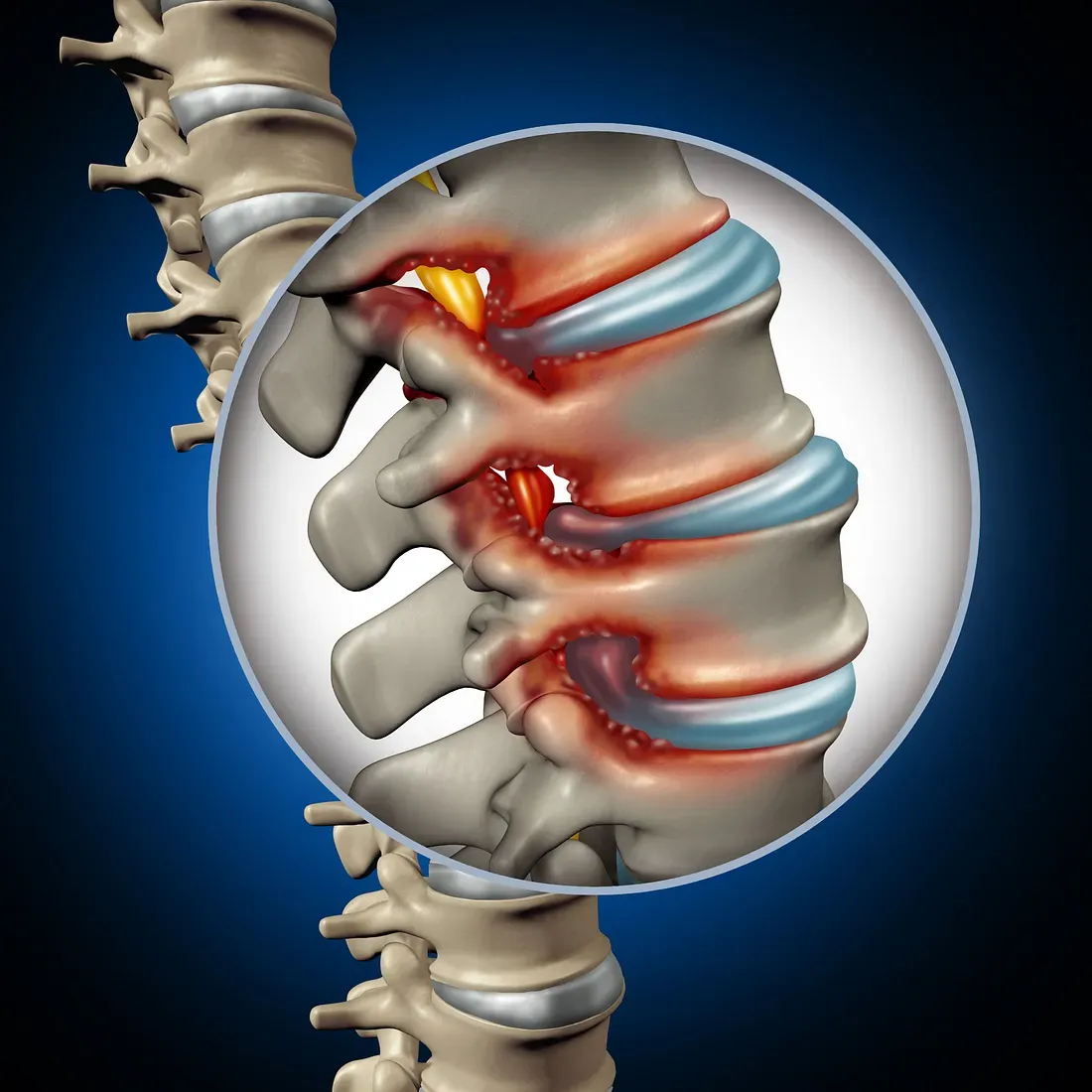 Spinal Stenosis Surgery: An Overview on Treatment Options