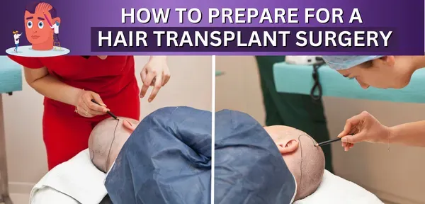 How To Prepare For Hair Transplant Surgery