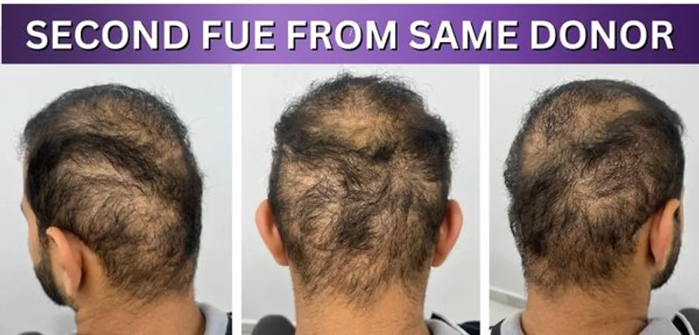 How A Second Repeat FUE Can Damage Your Hair?