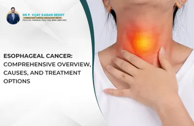 Esophageal Cancer: Comprehensive Overview, Causes, and Treatment Options