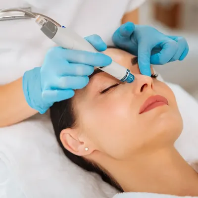 HydraFacial for Acne: Can It Help Clear Your Skin?