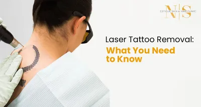 Laser Tattoo Removal: What You Need to Know
