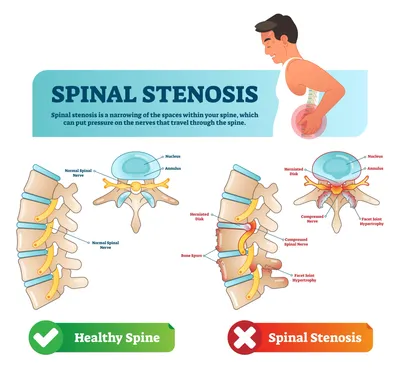 Decoding Spinal Stenosis Surgery: Options, Outcomes, and Recovery Insights