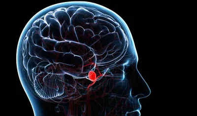 Brain Aneurysms: Detecting and Treating Before It's Too Late