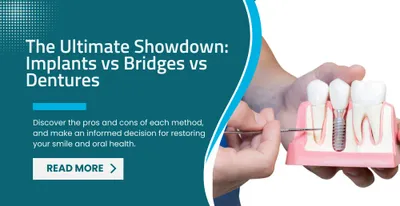 The Ultimate Showdown: Implants vs Bridges vs Dentures