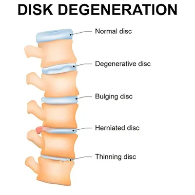Prevention is Key: Tips for Avoiding Degenerative Disc Disease