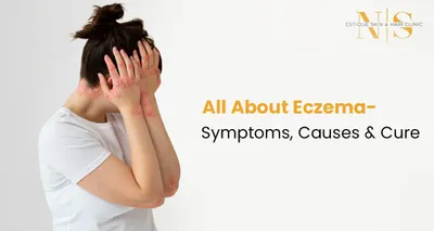 All About Eczema – Symptoms, Causes & Cure