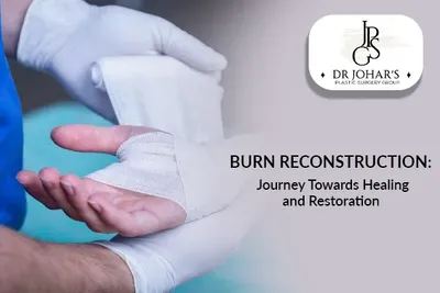 Burn Reconstruction: Journey Towards Healing and Restoration