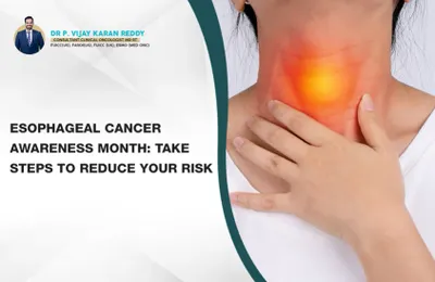 Esophageal Cancer Awareness Month: Take Steps to Reduce Your Risk