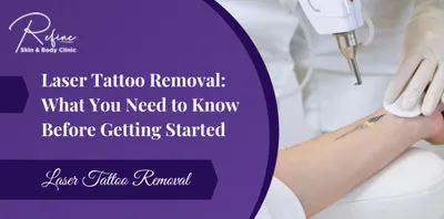Laser Tattoo Removal: What You Need to Know Before Getting Started