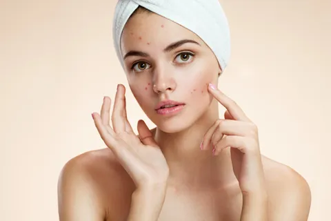 The Latest Advances in Acne Treatment Technology