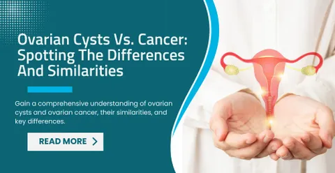 Ovarian Cysts Vs. Cancer: Spotting The Differences And Similarities
