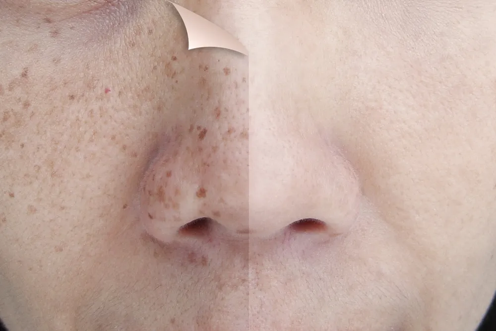Natural Remedies for Lightening Freckles: Do They Work?