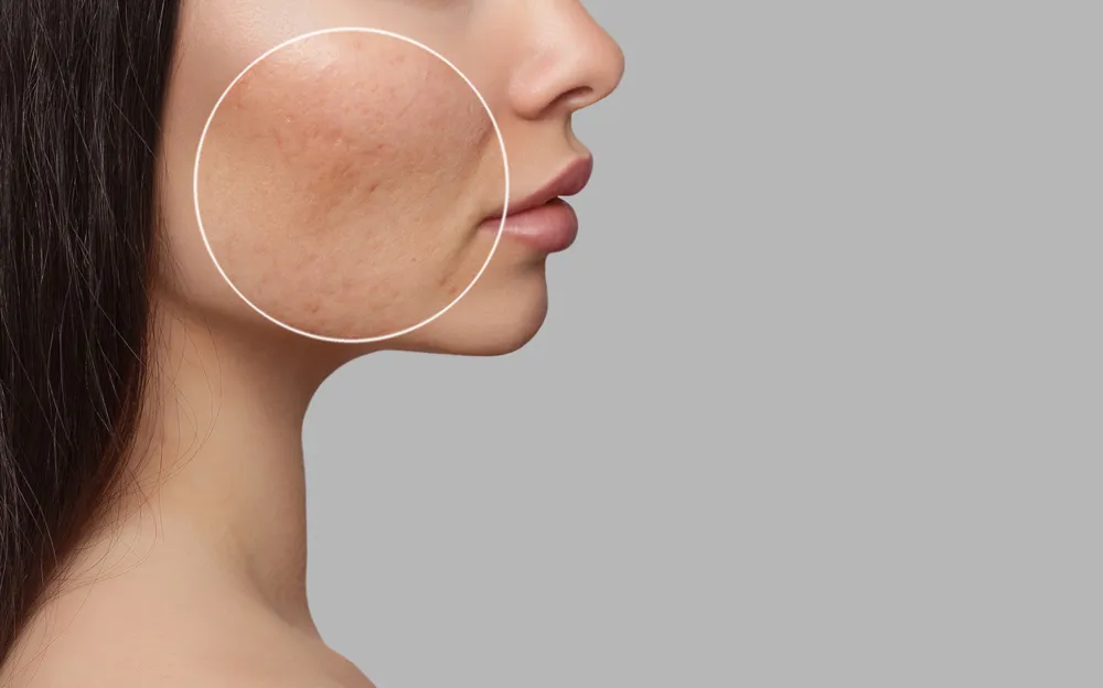 The Latest Advances in Acne Treatment: [A Complete Guide]