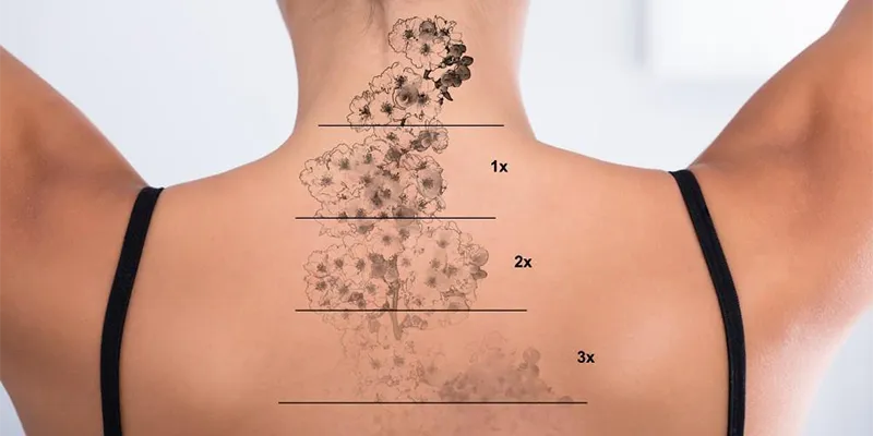 TATTOO REMOVAL PROGRESS