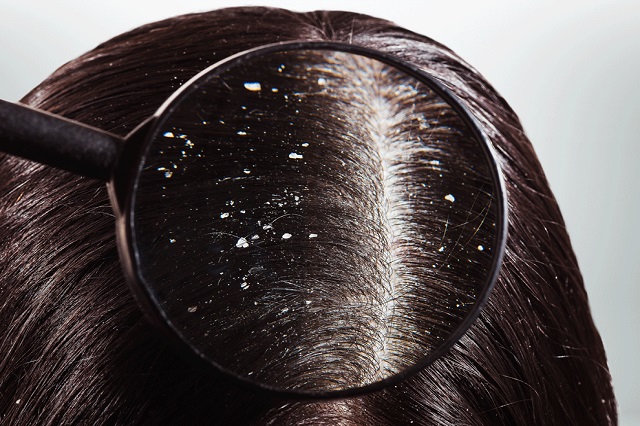 Hair Dandruff Treatment – Causes and Remedies