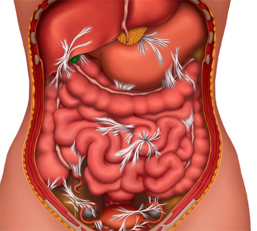 How to Loosen A Bowel Blockage – Symptoms, Causes And Solution