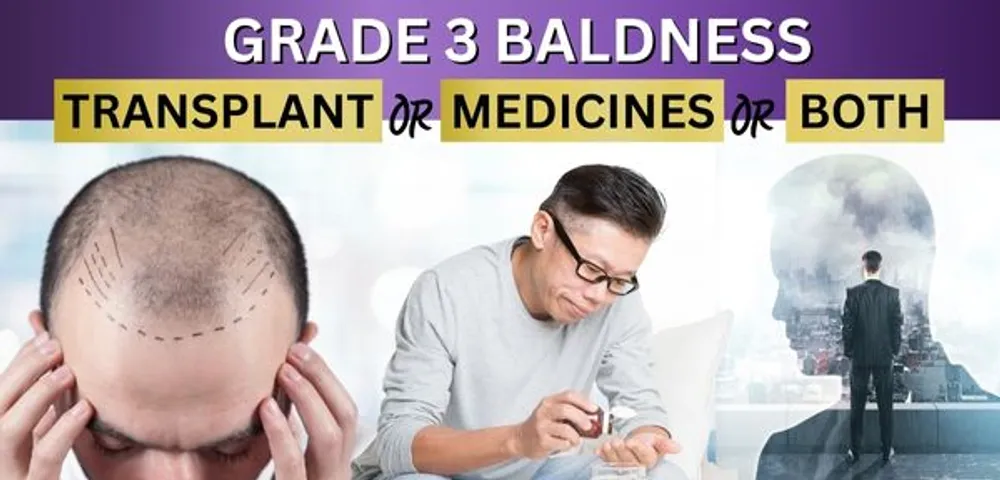 Approach in 50-year-old patient with Grade 3 baldness - Transplant or medicines or both?