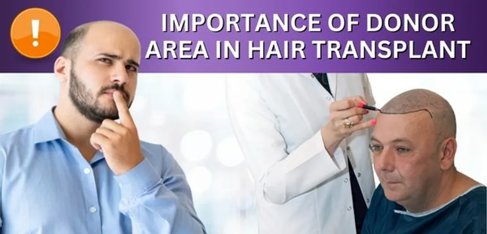 Importance of donor area for hair transplant