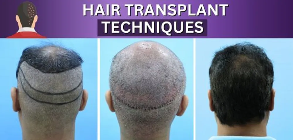 Understanding Different Hair Transplant Techniques