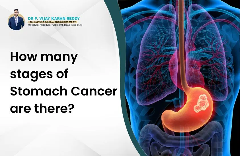 How many stages of Stomach Cancer are there?