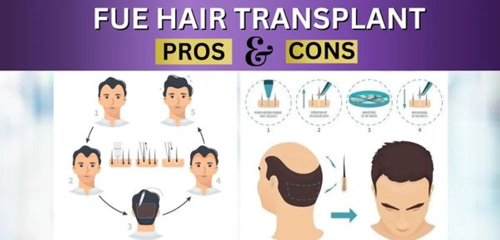 The Pros And Cons Of FUE Hair Transplant
