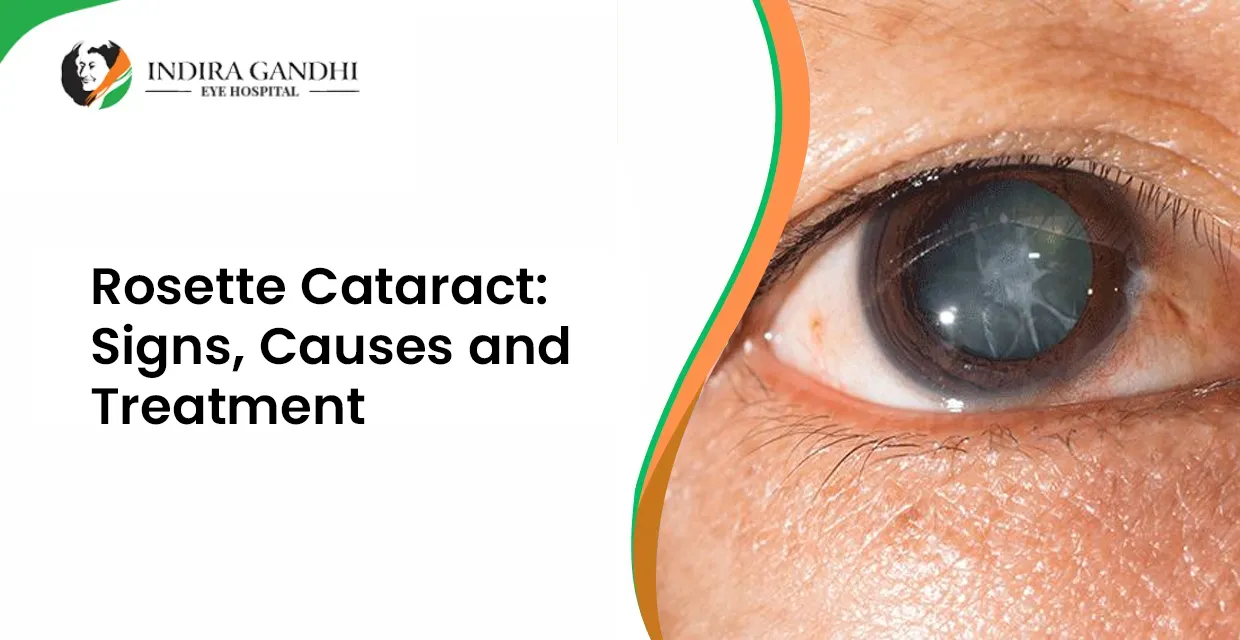Rosette Cataract: Signs, Causes and Treatment