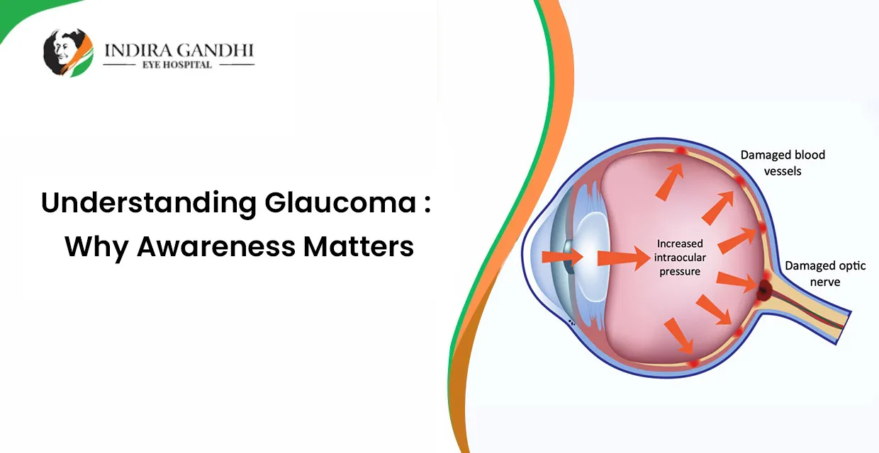 Understanding Glaucoma: Why Awareness Matters