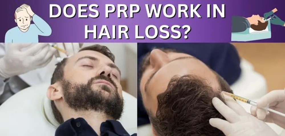 Hair Loss: Does PRP Work?