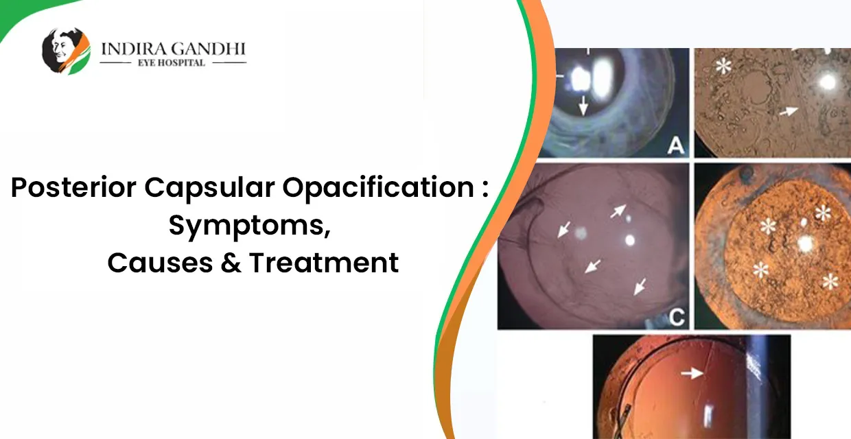 Posterior Capsular Opacification: Symptoms, Causes & Treatment