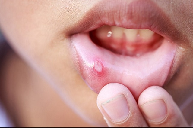 Mouth Blister Treatment – Causes and Symptoms