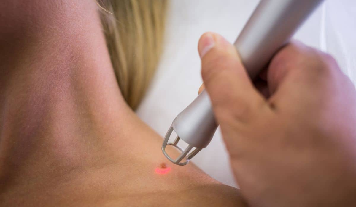 An Unseen Skin Problem: What are Skin Tags?