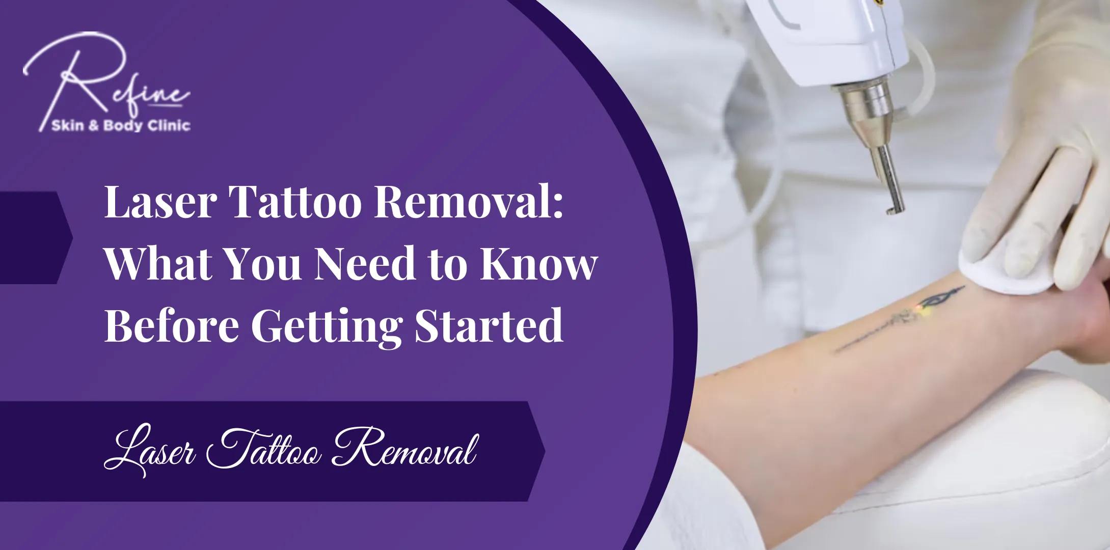 Laser Tattoo Removal: What You Need to Know Before Getting Started